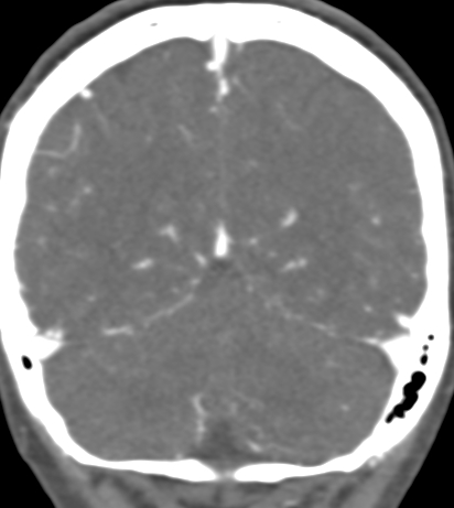 Basilar tip aneurysm with coiling (Radiopaedia 53912-60086 B 121).jpg