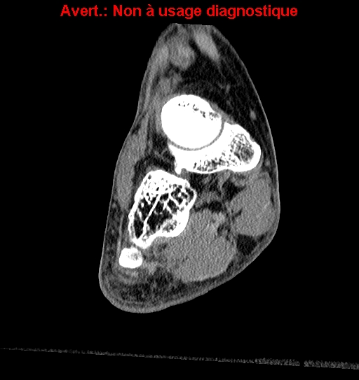 Baxter neuropathy (Radiopaedia 25988-26125 Coronal non-contrast 2).jpg