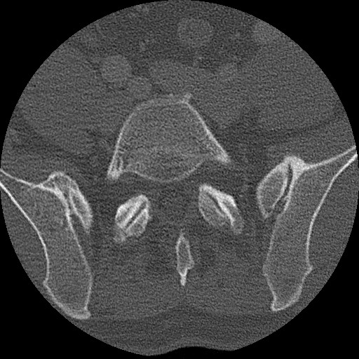 Benign post-traumatic pseudopneumoperitoneum (Radiopaedia 71199-81495 Axial bone window 278).jpg