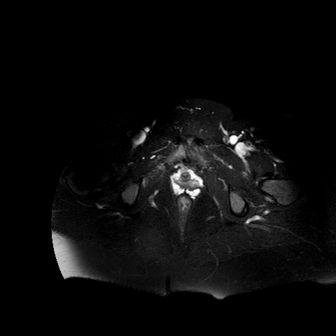 File:Benign seromucinous cystadenoma of the ovary (Radiopaedia 71065-81300 T2 SPAIR 2).jpg
