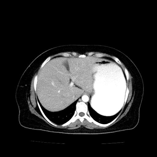 Benign spindle cell tumor - abdominopelvic (Radiopaedia 61300-69212 A 10).jpg