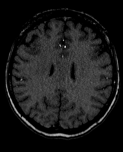 File:Berry aneurysm of the terminal internal carotid artery (Radiopaedia 88286-104918 Axial TOF 155).jpg