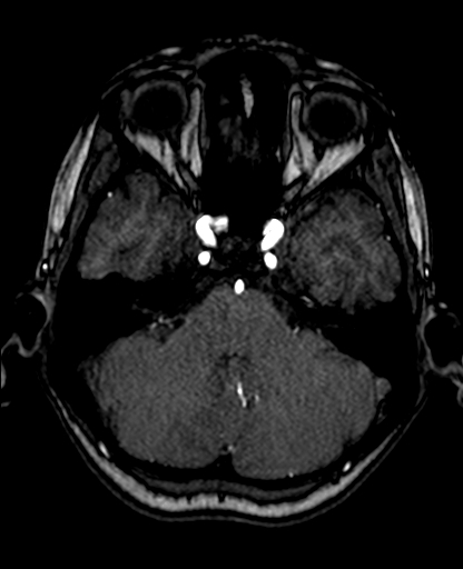 File:Berry aneurysm of the terminal internal carotid artery (Radiopaedia 88286-104918 Axial TOF 79).jpg