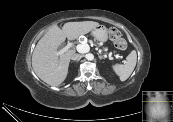 Bicameral celiacomesenteric aneurysm (Radiopaedia 55766-62327 A 18).jpg