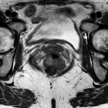File:Bicornuate uterus (Radiopaedia 61974-70046 Axial T2 22).jpg
