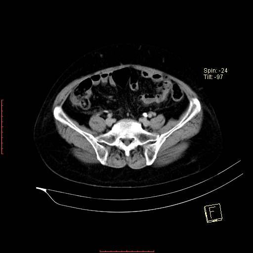 File:Bifid ureter (Radiopaedia 47604-52253 Axial C+ delayed 19).jpg