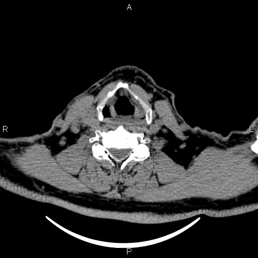 Bilateral Warthin tumors (Radiopaedia 84034-99263 Axial non-contrast 42).jpg
