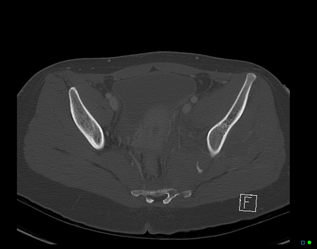 Bilateral acetabular fractures (Radiopaedia 79272-92308 Axial bone window 33).jpg