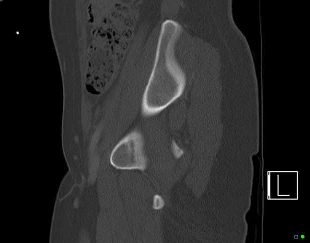 Bilateral acetabular fractures (Radiopaedia 79272-92308 Sagittal bone window 26).jpg
