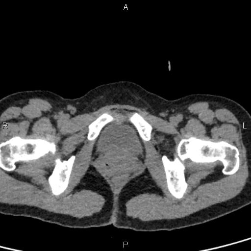 Bilateral adrenal gland hyperenhancement in pancreatitis (Radiopaedia 86642-102753 Axial non-contrast 109).jpg