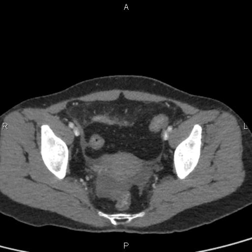 File:Bilateral adrenal gland hyperenhancement in pancreatitis (Radiopaedia 86642-102753 E 98).jpg