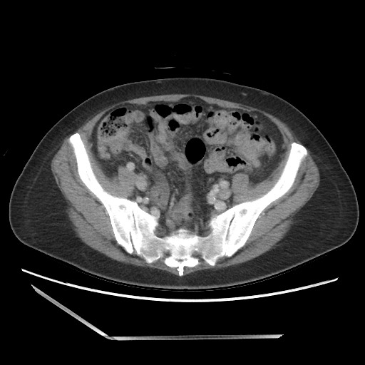 File:Bilateral adrenal granulocytic sarcomas (chloromas) (Radiopaedia 78375-91007 Axial 40).jpg
