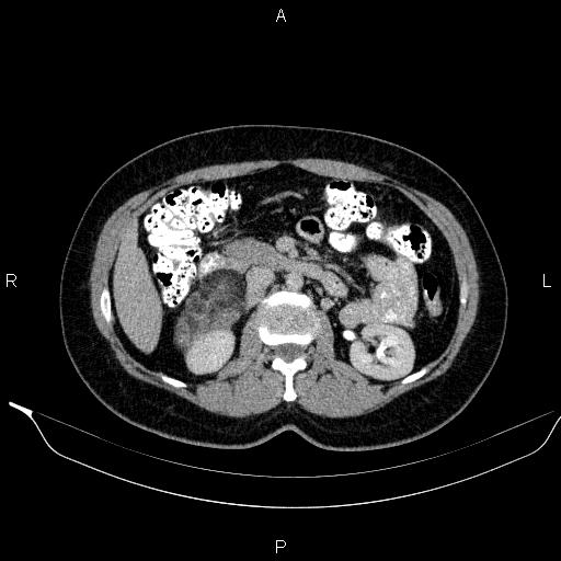 Bilateral adrenal myelolipoma (Radiopaedia 63058-71535 Axial C+ delayed 50).jpg