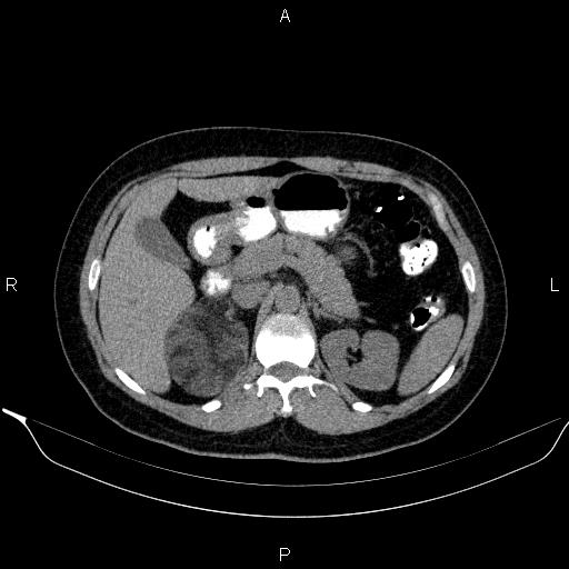 Bilateral adrenal myelolipoma (Radiopaedia 63058-71535 Axial non-contrast 53).jpg