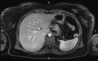 Bilateral adrenal myelolipoma (Radiopaedia 63058-71537 G 26).jpg