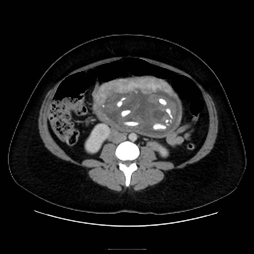 Bilateral adrenal thrombosis (Radiopaedia 58182-65256 A 40).jpg