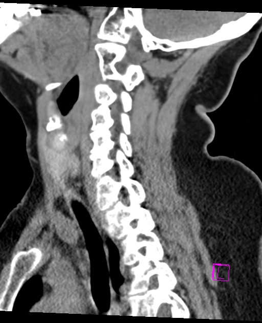 Bilateral atlanto-occipital assimilation (Radiopaedia 28350-28603 D 48).jpg