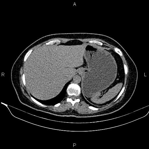Bilateral benign adrenal adenomas (Radiopaedia 86912-103124 Axial non-contrast 25).jpg