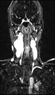 Bilateral carotid body tumors and right glomus jugulare tumor (Radiopaedia 20024-20060 MRA 99).jpg