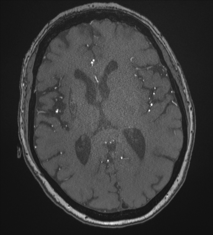 Bilateral fetal posterior communicating arteries (Radiopaedia 41286-44102 Axial MRA 120).png