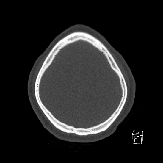 File:Bilateral occipital condyle fracture (type 2) (Radiopaedia 87675-104089 Axial bone window 115).jpg
