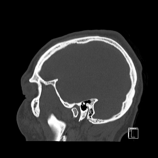 Bilateral occipital condyle fracture (type 2) (Radiopaedia 87675-104089 Sagittal bone window 96).jpg