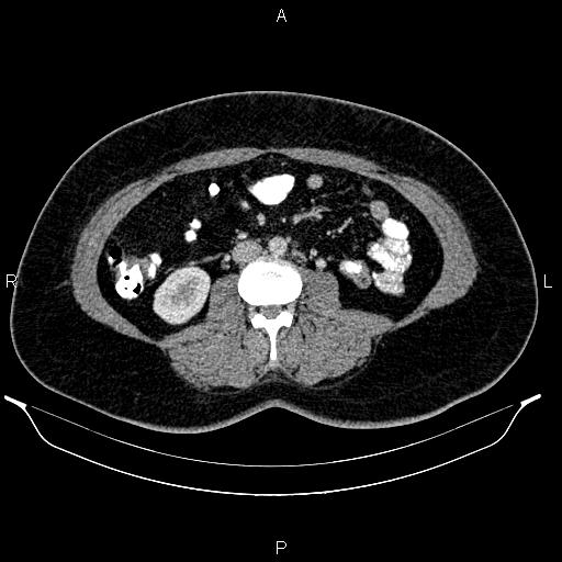 Bilateral ovarian dermoid cysts (Radiopaedia 85785-101603 A 58).jpg