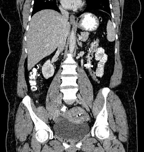 Bilateral ovarian dermoid cysts (Radiopaedia 85785-101603 C 30).jpg