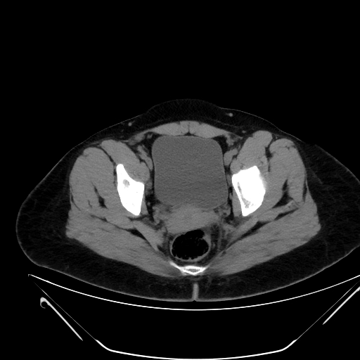 Bilateral ovarian mature cystic teratomas (Radiopaedia 79373-92457 Axial non-contrast 74).jpg