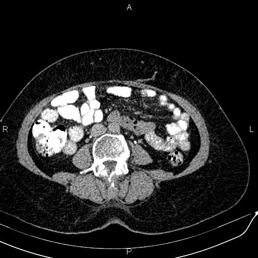 Bilateral ovarian serous cystadenocarcinoma (Radiopaedia 86062-101989 Axial C+ delayed 40).jpg