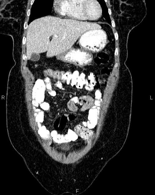 Bilateral ovarian serous cystadenocarcinoma (Radiopaedia 86062-101989 D 4).jpg