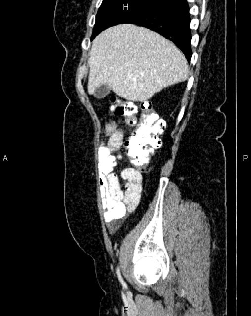 Bilateral ovarian serous cystadenocarcinoma (Radiopaedia 86062-101989 E 14).jpg