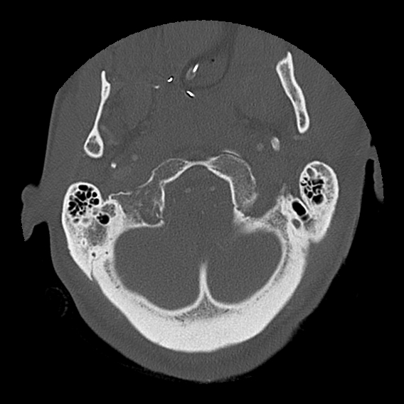 File:Bilateral perched facets with cord injury (Radiopaedia 45587-49713 Axial bone window 19).jpg