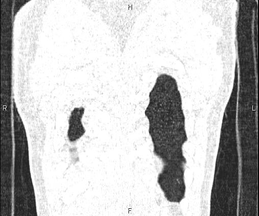 Bilateral pulmonary AVM (Radiopaedia 83134-97505 Coronal lung window 74).jpg