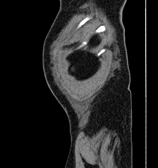 Bilateral rectus sheath hematomas (Radiopaedia 50778-56252 B 75).jpg