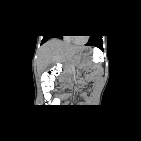 File:Bilateral renal malrotation (Radiopaedia 30901-31606 B 51).jpg