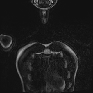 File:Bilateral spinoglenoid notch ganglion cysts (Radiopaedia 29577-30082 Coronal T2 8).jpg