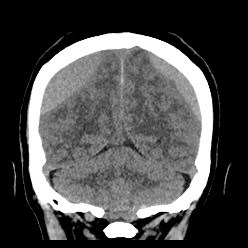 Bilateral subacute subdural hematoma (Radiopaedia 69240-79018 Coronal non-contrast 43).jpg