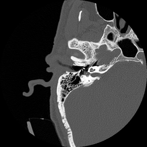 File:Bilateral temporal bone fractures (Radiopaedia 29482-29970 Axial non-contrast 24).jpg
