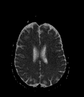 File:Bilateral thalamic glioma (Radiopaedia 65852-75009 Axial ADC 15).jpg
