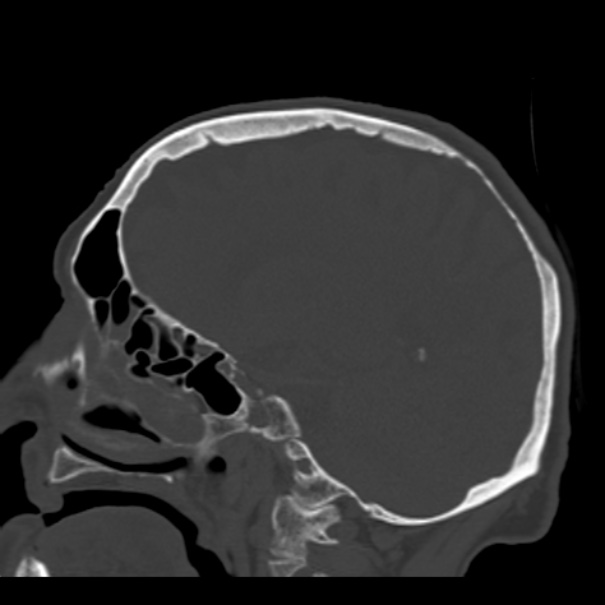 Biparietal osteodystrophy (Radiopaedia 46109-50463 Sagittal bone window 66).jpg