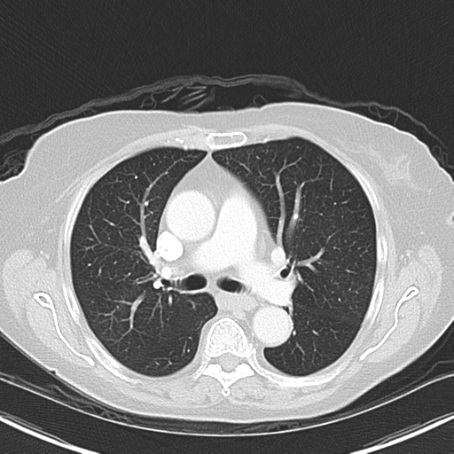 File:Bladder and bowel cancers (Radiopaedia 37688-39592 Axial lung window 23).png