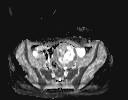 File:Bladder rhabdomyosarcoma (Radiopaedia 27231-27407 Axial ADC 15).jpg