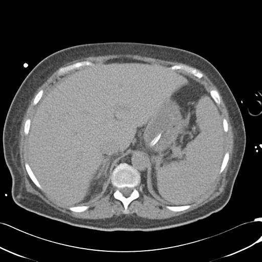 File:Bladder rupture post renal biopsy (Radiopaedia 30863-31572 Axial non-contrast 20).jpg