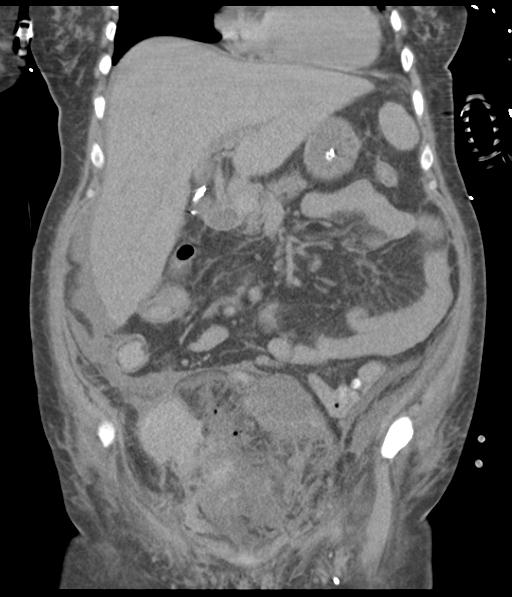 File:Bladder rupture post renal biopsy (Radiopaedia 30863-31572 Coronal non-contrast 24).jpg