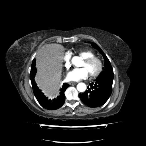 Bladder tumor detected on trauma CT (Radiopaedia 51809-57609 A 59).jpg