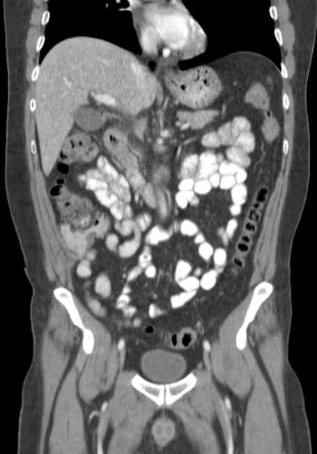 Bleeding duodenal ulcer and adenomyomatosis of gallbladder (Radiopaedia 61834-69861 B 47).jpg