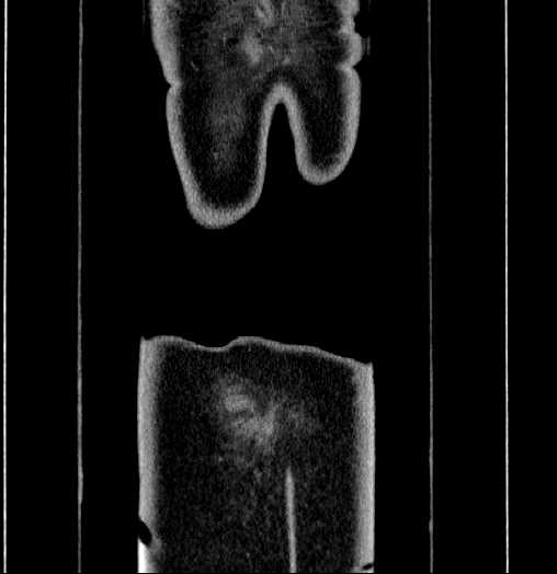Blind-ending branch of a bifid ureter (Radiopaedia 61159-69048 C 72).jpg