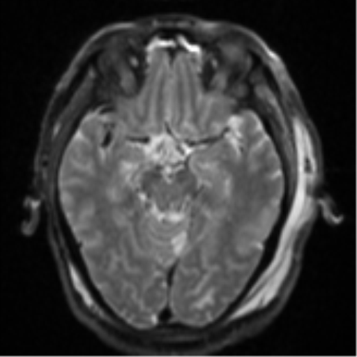 Blunt cerebrovascular injury (Radiopaedia 53682-59745 Axial DWI 13).png
