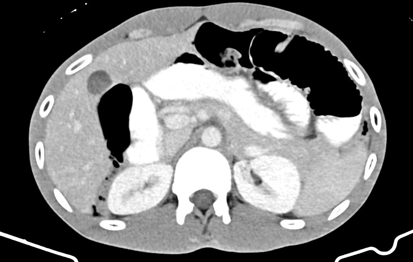 Blunt injury to the small bowel (Radiopaedia 74953-85987 A 40).jpg